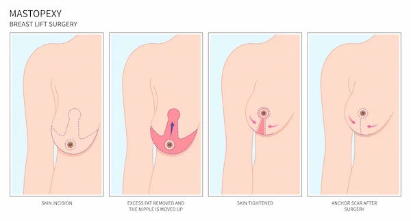 Fat Transfer Breast Reconstruction